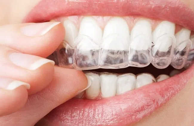 ホームホワイトニング