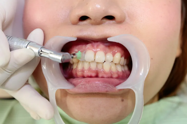 歯のクリーニングを行います