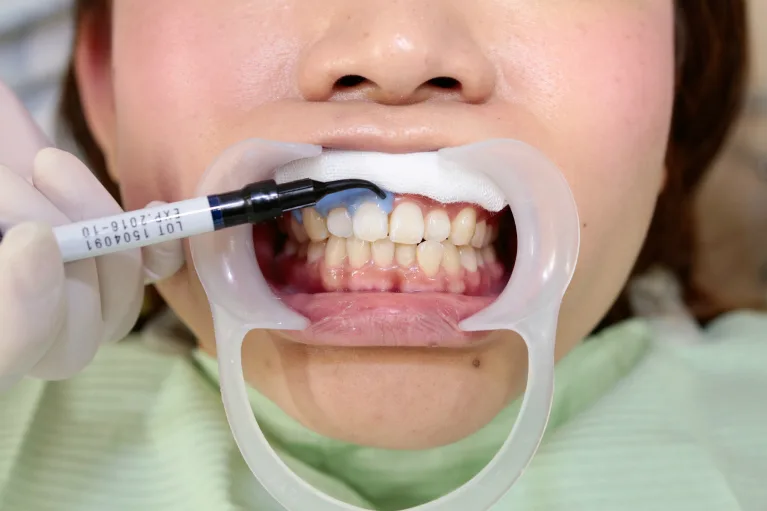 ホワイトニングジェルの塗布